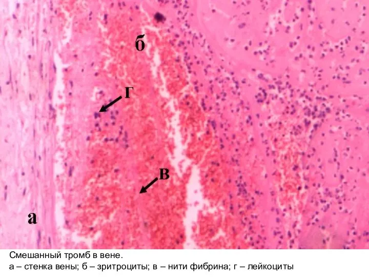 Смешанный тромб в вене. а – стенка вены; б – зритроциты;