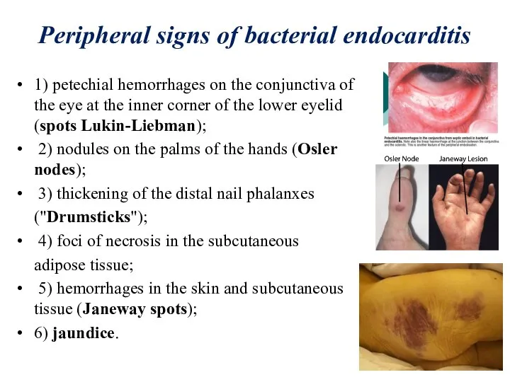 Peripheral signs of bacterial endocarditis 1) petechial hemorrhages on the conjunctiva