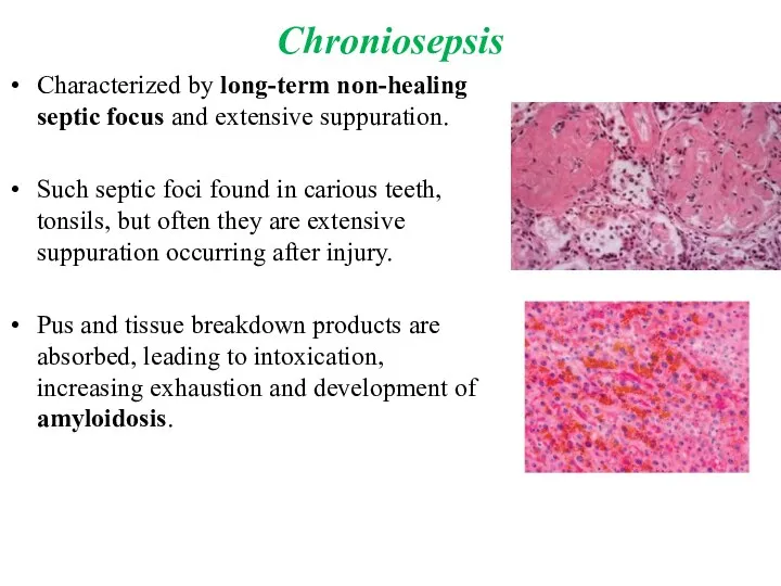 Chroniosepsis Characterized by long-term non-healing septic focus and extensive suppuration. Such