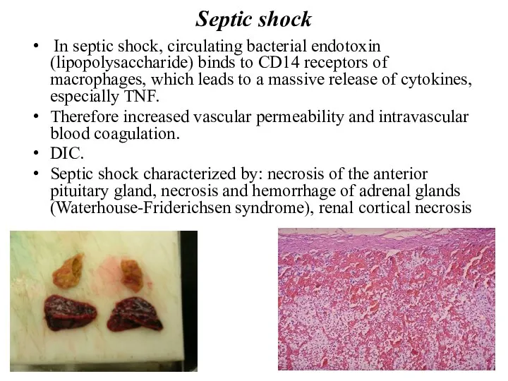 Septic shock In septic shock, circulating bacterial endotoxin (lipopolysaccharide) binds to