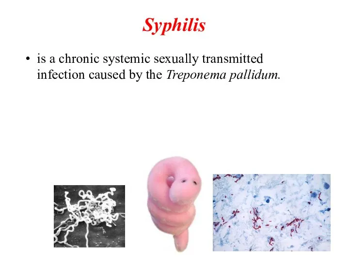 Syphilis is a chronic systemic sexually transmitted infection caused by the Treponema pallidum.