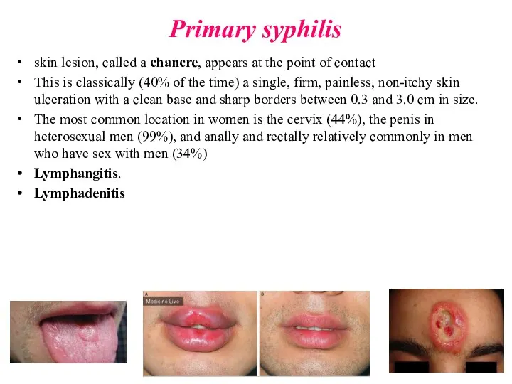 Primary syphilis skin lesion, called a chancre, appears at the point