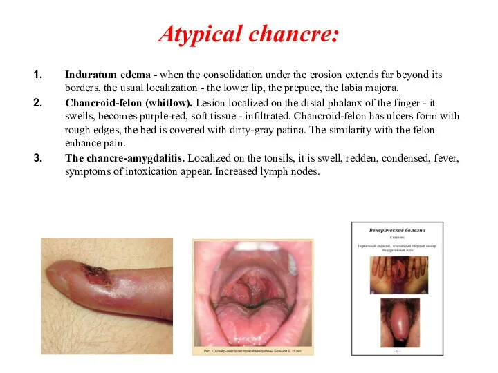 Atypical chancre: Induratum edema - when the consolidation under the erosion