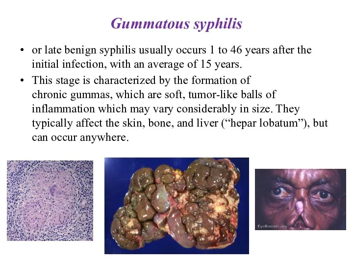 Gummatous syphilis or late benign syphilis usually occurs 1 to 46