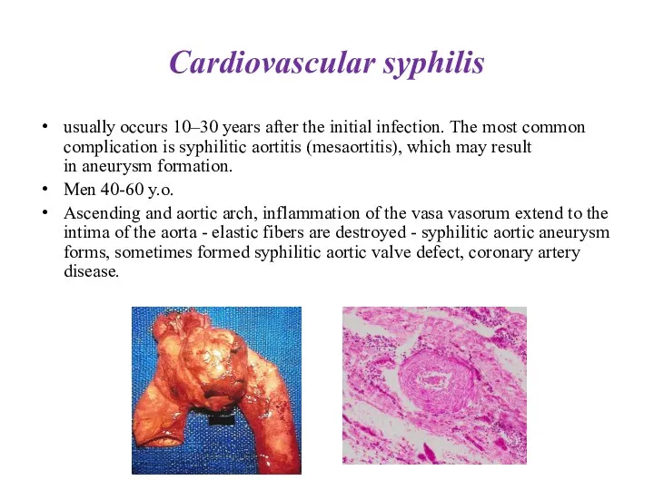 Cardiovascular syphilis usually occurs 10–30 years after the initial infection. The