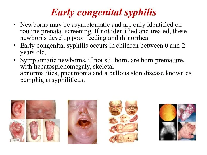 Early congenital syphilis Newborns may be asymptomatic and are only identified