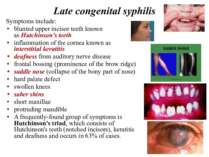 Late congenital syphilis Symptoms include: blunted upper incisor teeth known as