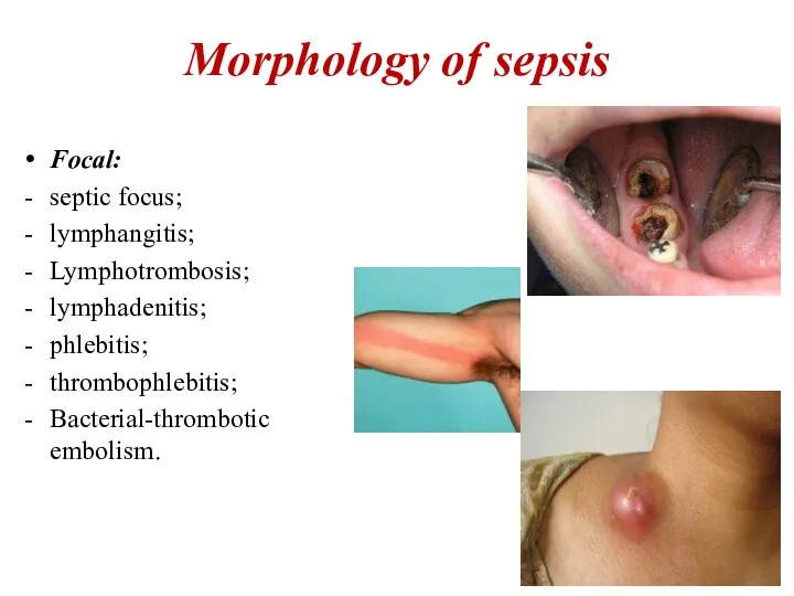 Morphology of sepsis Focal: septic focus; lymphangitis; Lymphotrombosis; lymphadenitis; phlebitis; thrombophlebitis; Bacterial-thrombotic embolism.