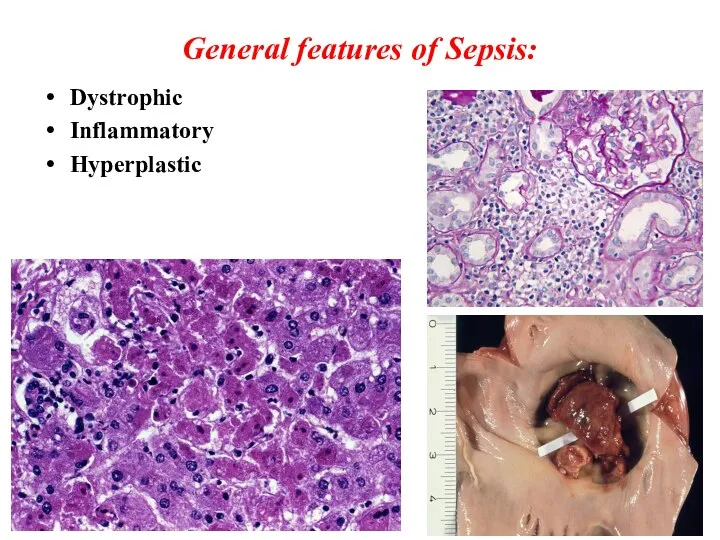 General features of Sepsis: Dystrophic Inflammatory Hyperplastic