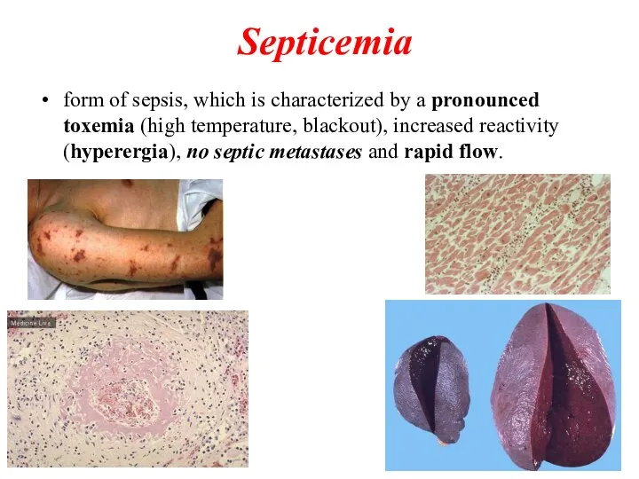 Septicemia form of sepsis, which is characterized by a pronounced toxemia