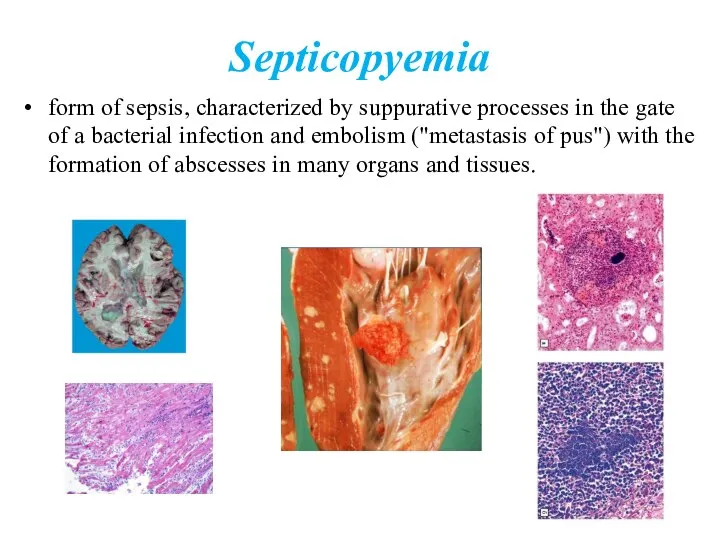 Septicopyemia form of sepsis, characterized by suppurative processes in the gate