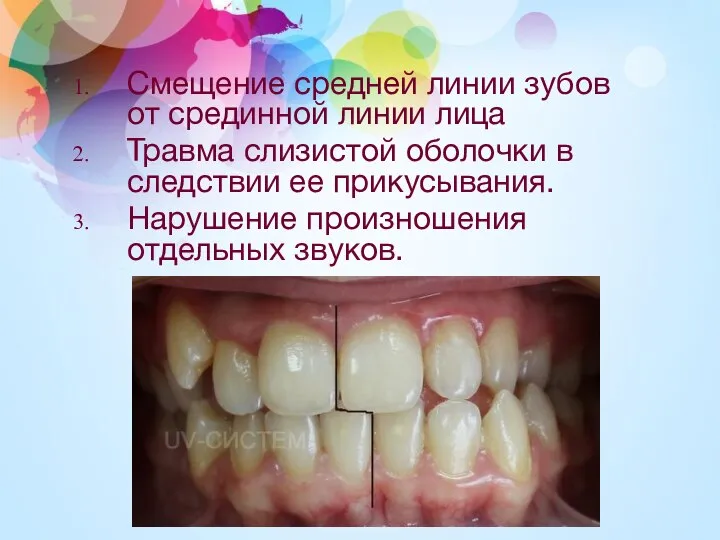 Смещение средней линии зубов от срединной линии лица Травма слизистой оболочки