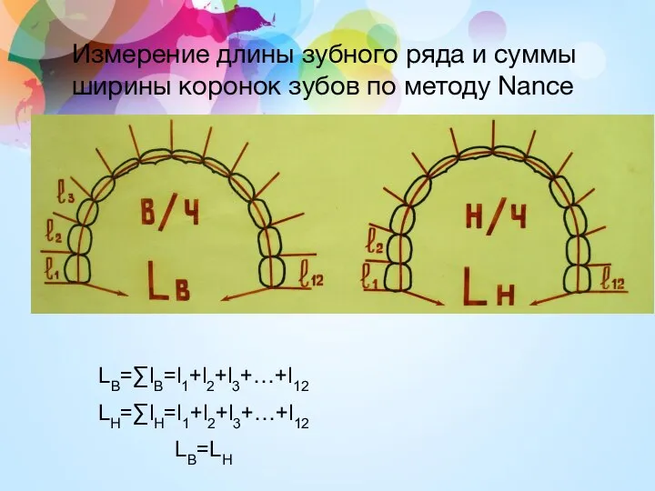 Измерение длины зубного ряда и суммы ширины коронок зубов по методу Nance LB=∑lB=l1+l2+l3+…+l12 LH=∑lH=l1+l2+l3+…+l12 LB=LH