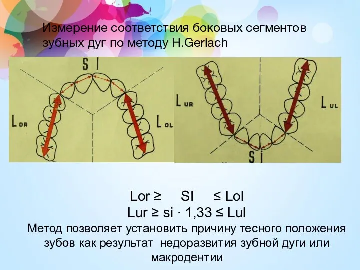 Измерение соответствия боковых сегментов зубных дуг по методу H.Gerlach Lor ≥