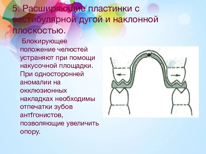 5. Расширяющие пластинки с вестибулярной дугой и наклонной плоскостью. Блокирующее положение