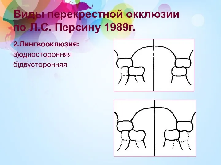 Виды перекрестной окклюзии по Л.С. Персину 1989г. 2.Лингвооклюзия: а)односторонняя б)двусторонняя