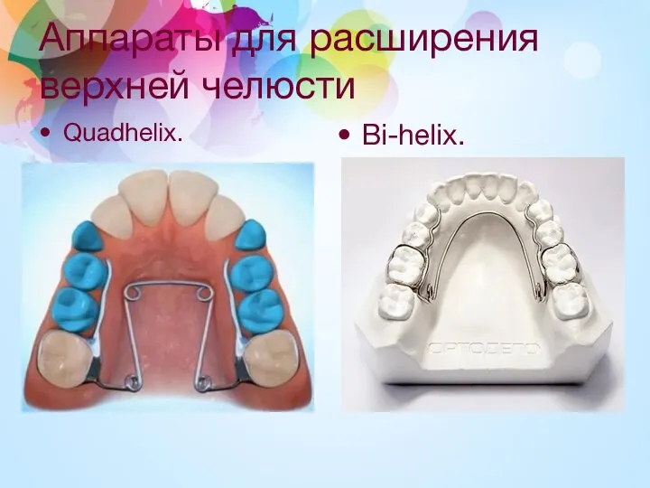 Аппараты для расширения верхней челюсти Quadhelix. Bi-helix.