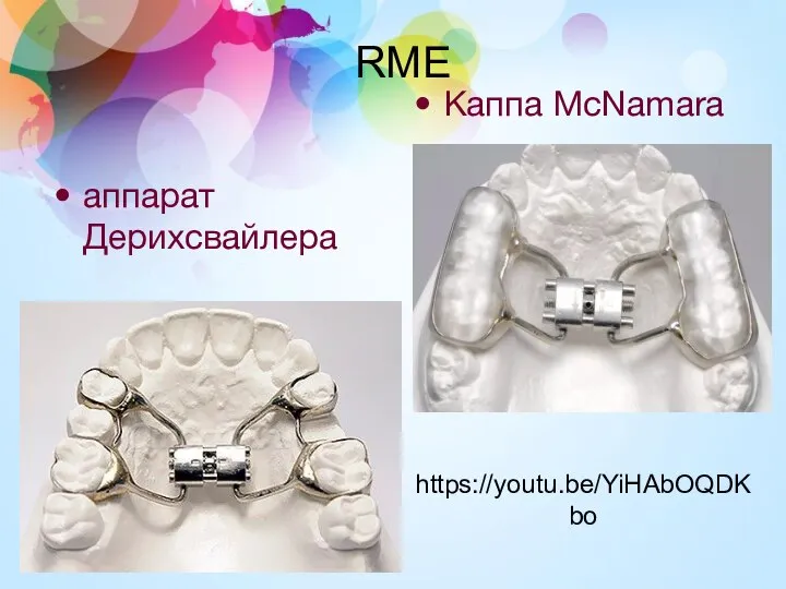 аппарат Дерихсвайлера Каппа McNamara RME https://youtu.be/YiHAbOQDKbo