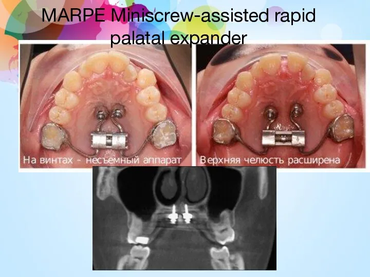 MARPE Miniscrew-assisted rapid palatal expander