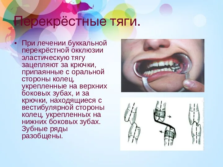 Перекрёстные тяги. При лечении буккальной перекрёстной окклюзии эластическую тягу зацепляют за