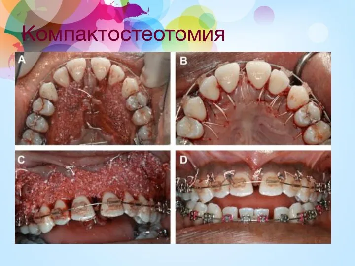 Компактостеотомия