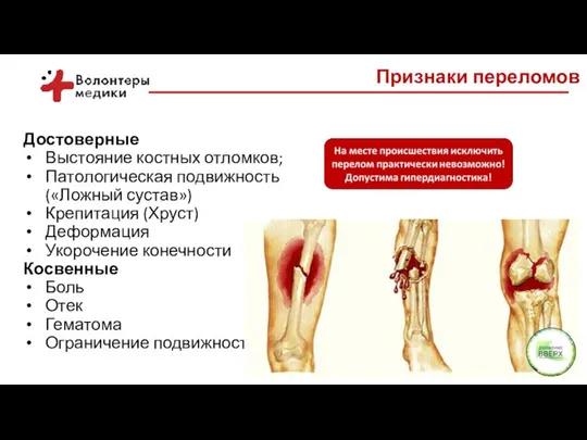 Признаки переломов Достоверные Выстояние костных отломков; Патологическая подвижность («Ложный сустав») Крепитация