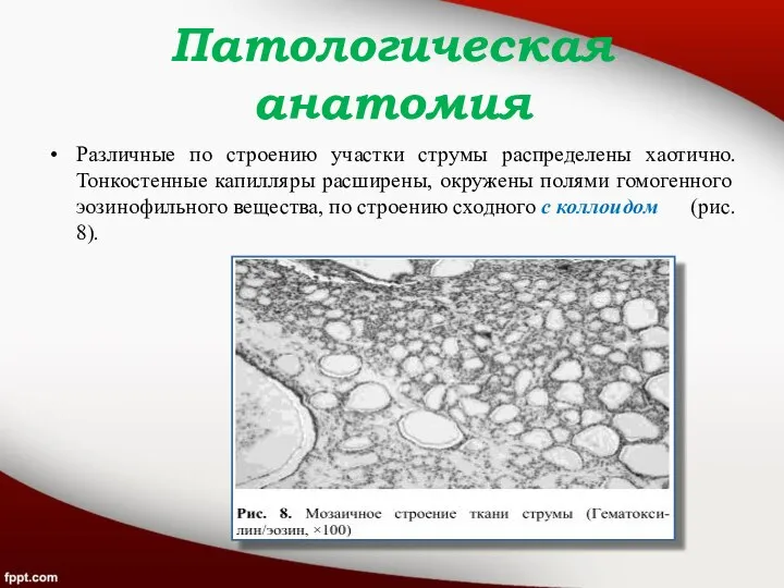 Патологическая анатомия Различные по строению участки струмы распределены хаотично. Тонкостенные капилляры