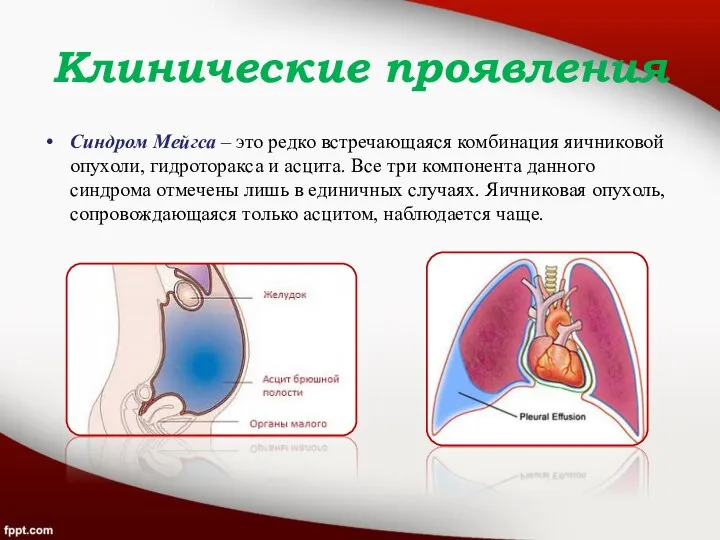 Клинические проявления Синдром Мейгса – это редко встречающаяся комбинация яичниковой опухоли,