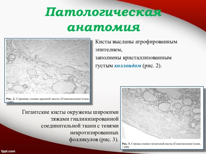 Патологическая анатомия Кисты высланы атрофированным эпителием, заполнены кристаллизованным густым коллоидом (рис.