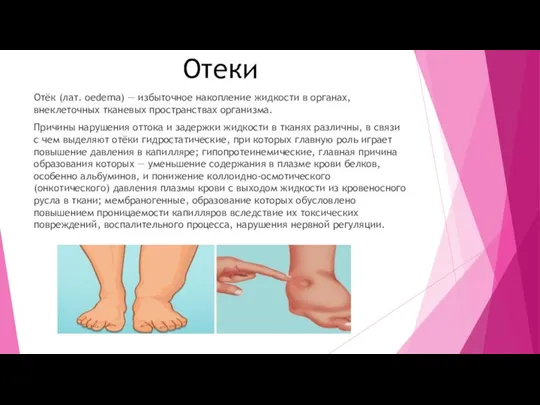 Отеки Отёк (лат. oedema) — избыточное накопление жидкости в органах, внеклеточных