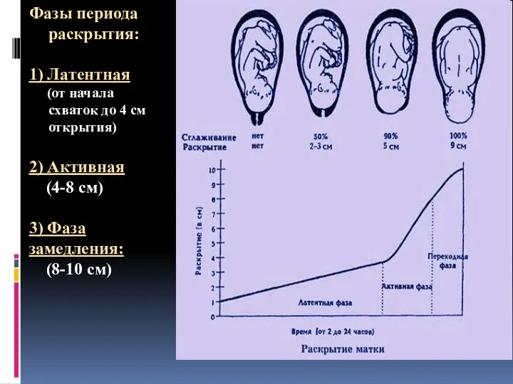 Фазы периода раскрытия: 1) Латентная (от начала схваток до 4 см