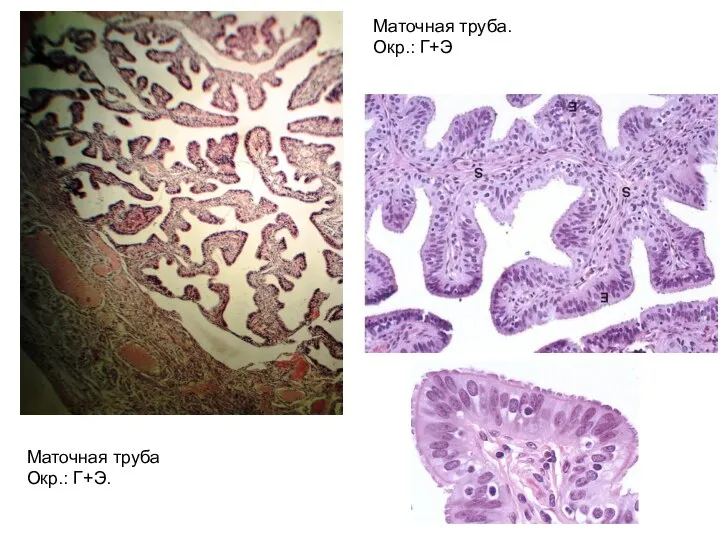 Маточная труба. Окр.: Г+Э Маточная труба Окр.: Г+Э.