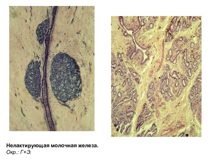 Нелактирующая молочная железа. Окр.: Г+Э.