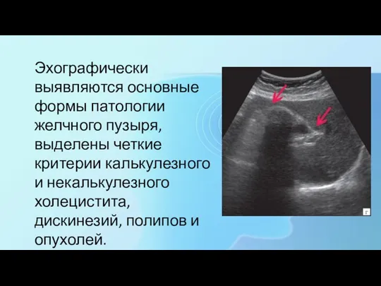 Эхографически выявляются основные формы патологии желчного пузыря, выделены четкие критерии калькулезного