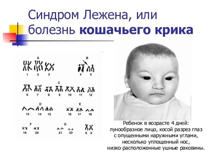 Синдром Лежена, или болезнь кошачьего крика Ребенок в возрасте 4 дней: