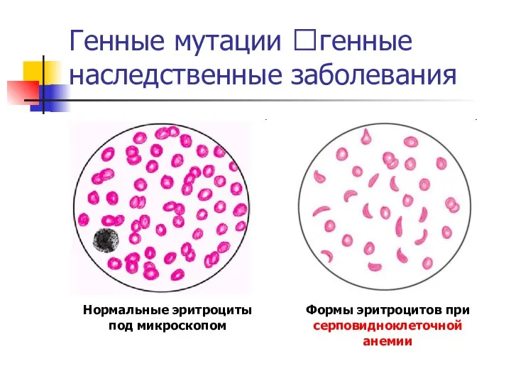 Генные мутации ?генные наследственные заболевания Нормальные эритроциты под микроскопом Формы эритроцитов при серповидноклеточной анемии