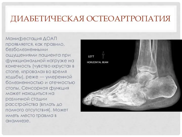 ДИАБЕТИЧЕСКАЯ ОСТЕОАРТРОПАТИЯ Манифестация ДОАП проявляется, как правило, безболезненными ощущениями пациента при