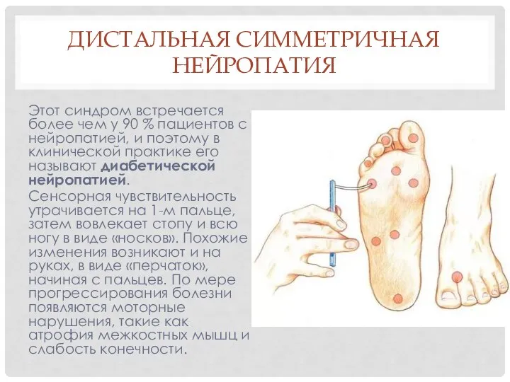 ДИСТАЛЬНАЯ СИММЕТРИЧНАЯ НЕЙРОПАТИЯ Этот синдром встречается более чем у 90 %