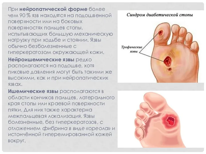 При нейропатической форме более чем 90 % язв находятся на подошвенной