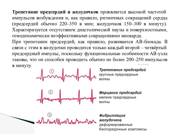 Трепетание предсердий и желудочков проявляется высокой частотой импульсов возбуждения и, как