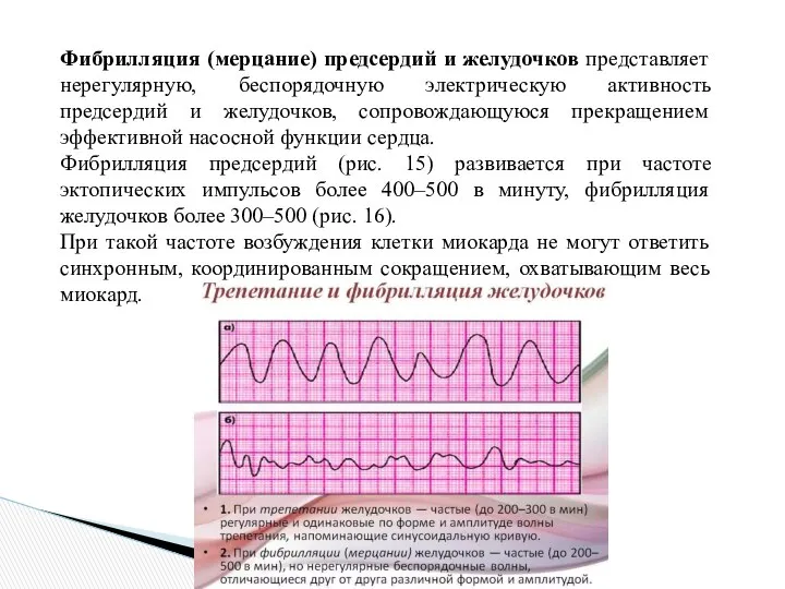 Фибрилляция (мерцание) предсердий и желудочков представляет нерегулярную, беспорядочную электрическую активность предсердий