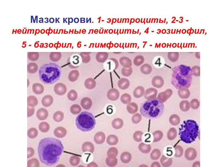 Мазок крови. 1- эритроциты, 2-3 -нейтрофильные лейкоциты, 4 - эозинофил, 5