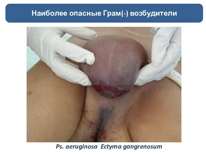 Наиболее опасные Грам(-) возбудители Ps. aeruginosa Ectyma gangrenosum