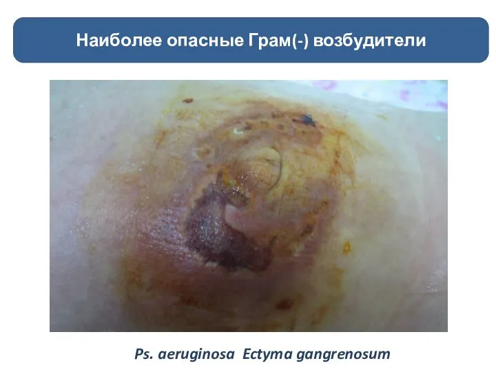 Наиболее опасные Грам(-) возбудители Ps. aeruginosa Ectyma gangrenosum