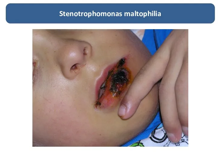 Stenotrophomonas maltophilia