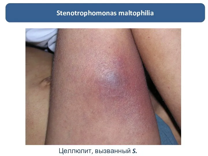 Целлюлит, вызванный S. maltophilia Stenotrophomonas maltophilia