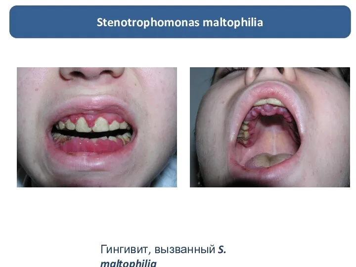 Stenotrophomonas maltophilia Гингивит, вызванный S. maltophilia