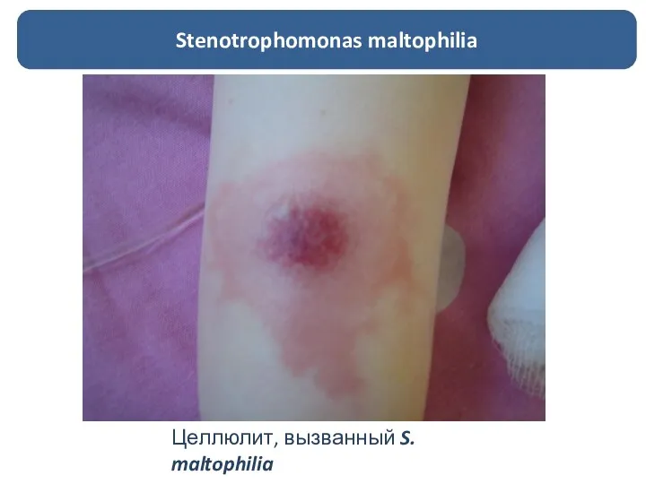 Целлюлит, вызванный S. maltophilia Stenotrophomonas maltophilia