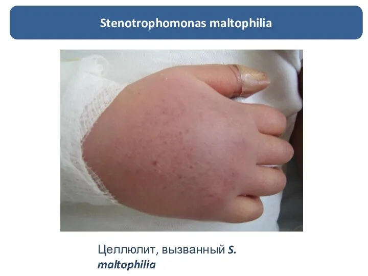 Stenotrophomonas maltophilia Целлюлит, вызванный S. maltophilia