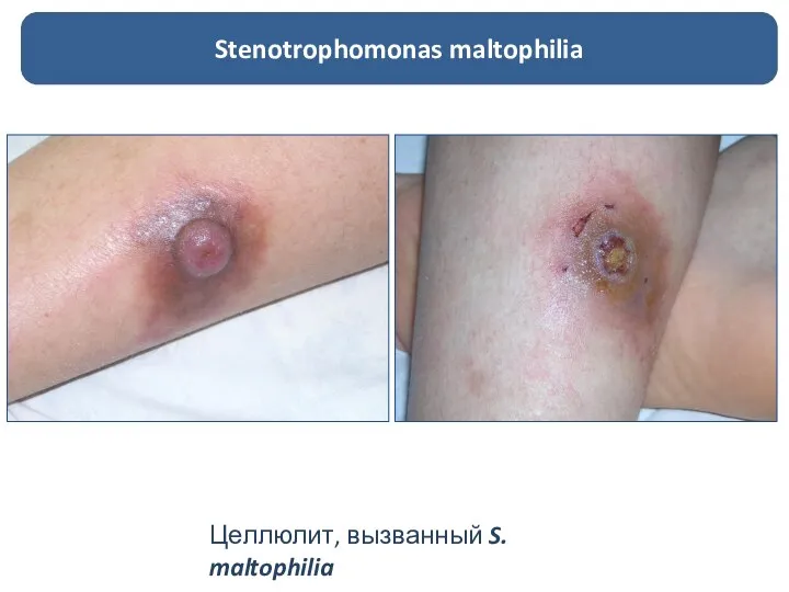 Stenotrophomonas maltophilia Целлюлит, вызванный S. maltophilia